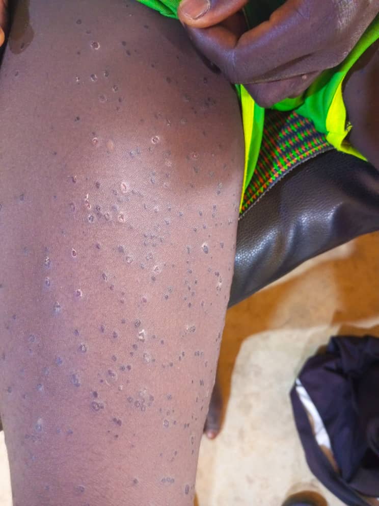 Photo 2: Situation of YS lesions at D14 after the start of the eruption