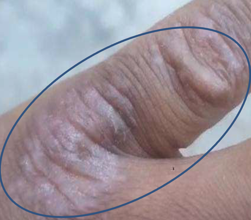 Figure 1: The inflamed skin infected with Kluyveromyces marxianus