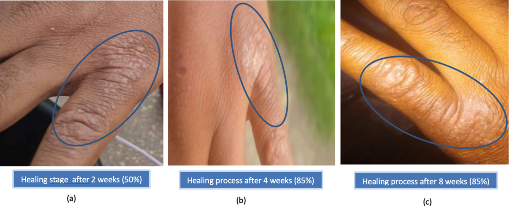 Figure (7a): The healing process after two weeks (50%) of administration of ketoconazole, both oral and topical (7b): The healing process after four weeks (85%) of administration of ketoconazole, both oral and topical (7C): The healing process after eight weeks (85%) of administration of ketoconazole, both oral and topical