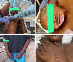 Figure 3 : mpox lesions in inmates. n=45. mpox outbreak in 3 military prisons in Kinshasa, DRC, October 2024 to January 2025